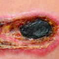 Necrosis Symptoms What Does Necrotic Skin Tissue Smell Like and Why Odor Signals Serious Health Issues