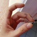 The Wonders of Silver Nitrate: Understanding its Healing Properties