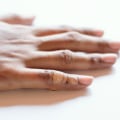 1st vs 2nd vs 3rd Degree Burns: How to Spot Burn Severity and Care the Right Way