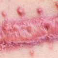The Power of Silver Nitrate Treatment in Wound Care