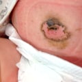 The Healing Power of Silver Nitrate Exposure