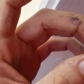 What Silver Nitrate Sticks on Skin Actually Do to Wounds