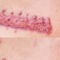 The Benefits of Silver Nitrate in Wound Care