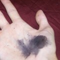What Does An Infected Wound Smell Like? Combat Infections With Silver Nitrate