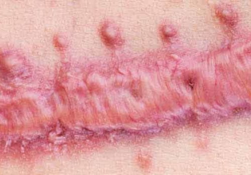 The Power of Silver Nitrate Treatment in Wound Care