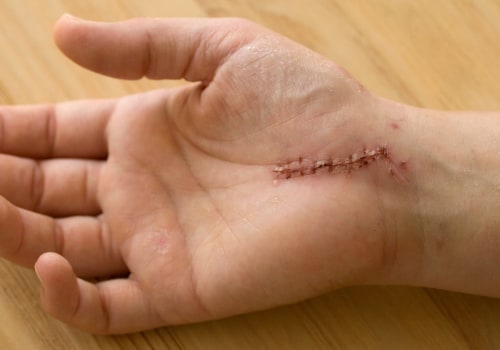 Scar Tissue Pain After Injury? Find Out Why It Hurts