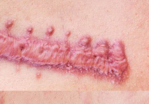 The Benefits of Silver Nitrate in Wound Care