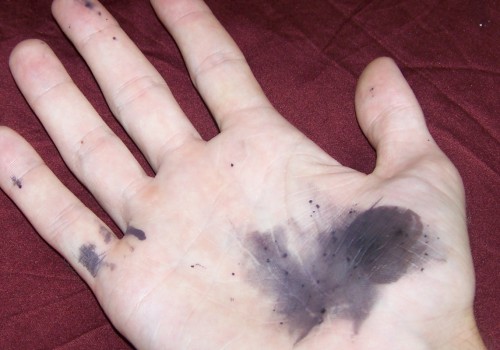 What Does An Infected Wound Smell Like? Combat Infections With Silver Nitrate